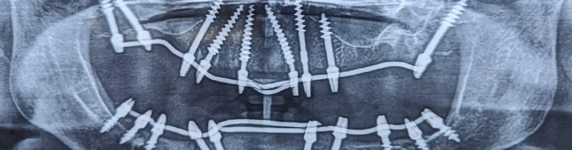 best basal implants, dental implants in punjabi bagh and rajouri garden by Denta Crest