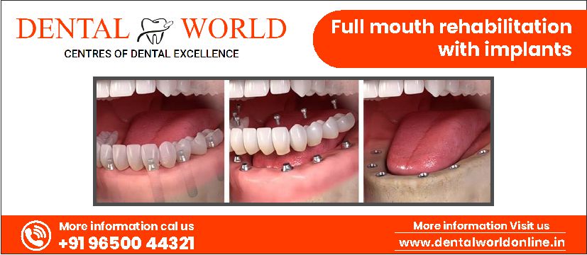 full mouth rehabilitation in punjabi bagh and rajouri garden with dental implants by Denta Crest