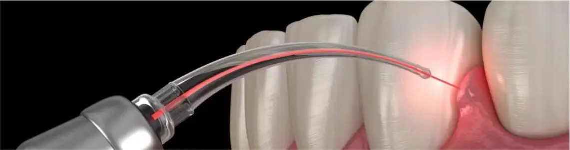 periodontics and gums treatments by Denta Crest in punjabi bagh and rajouri garden